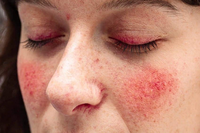 A female with a skin condition called rosacea
