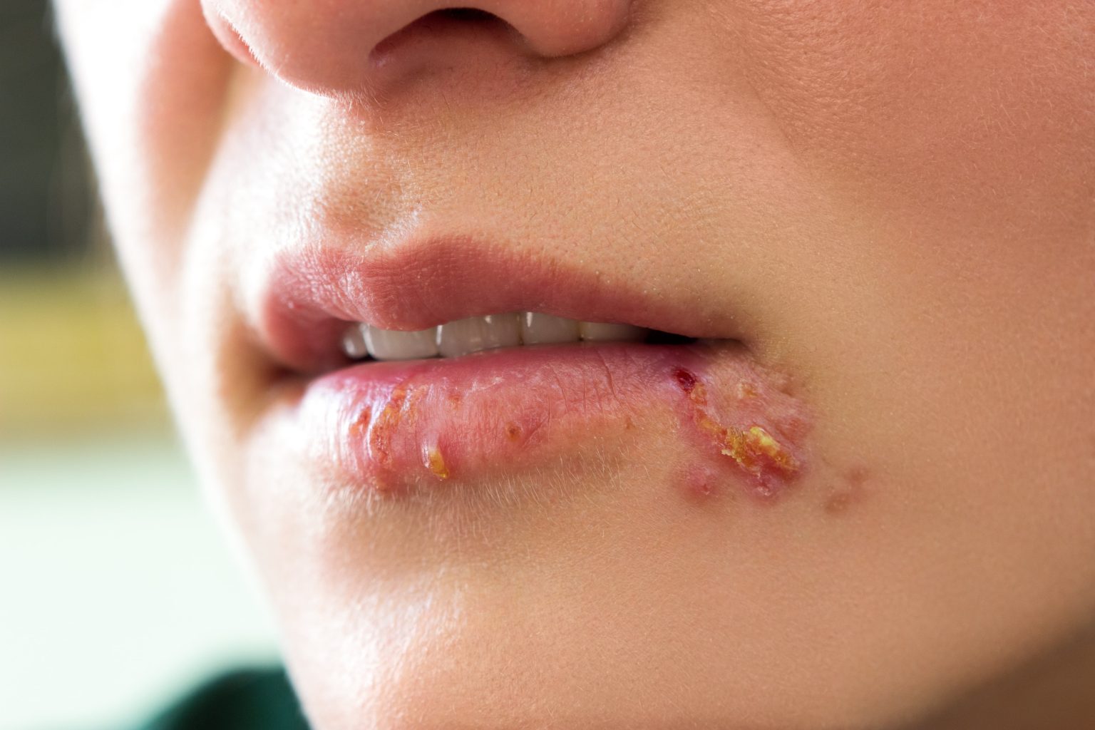 person-with-cold-sores