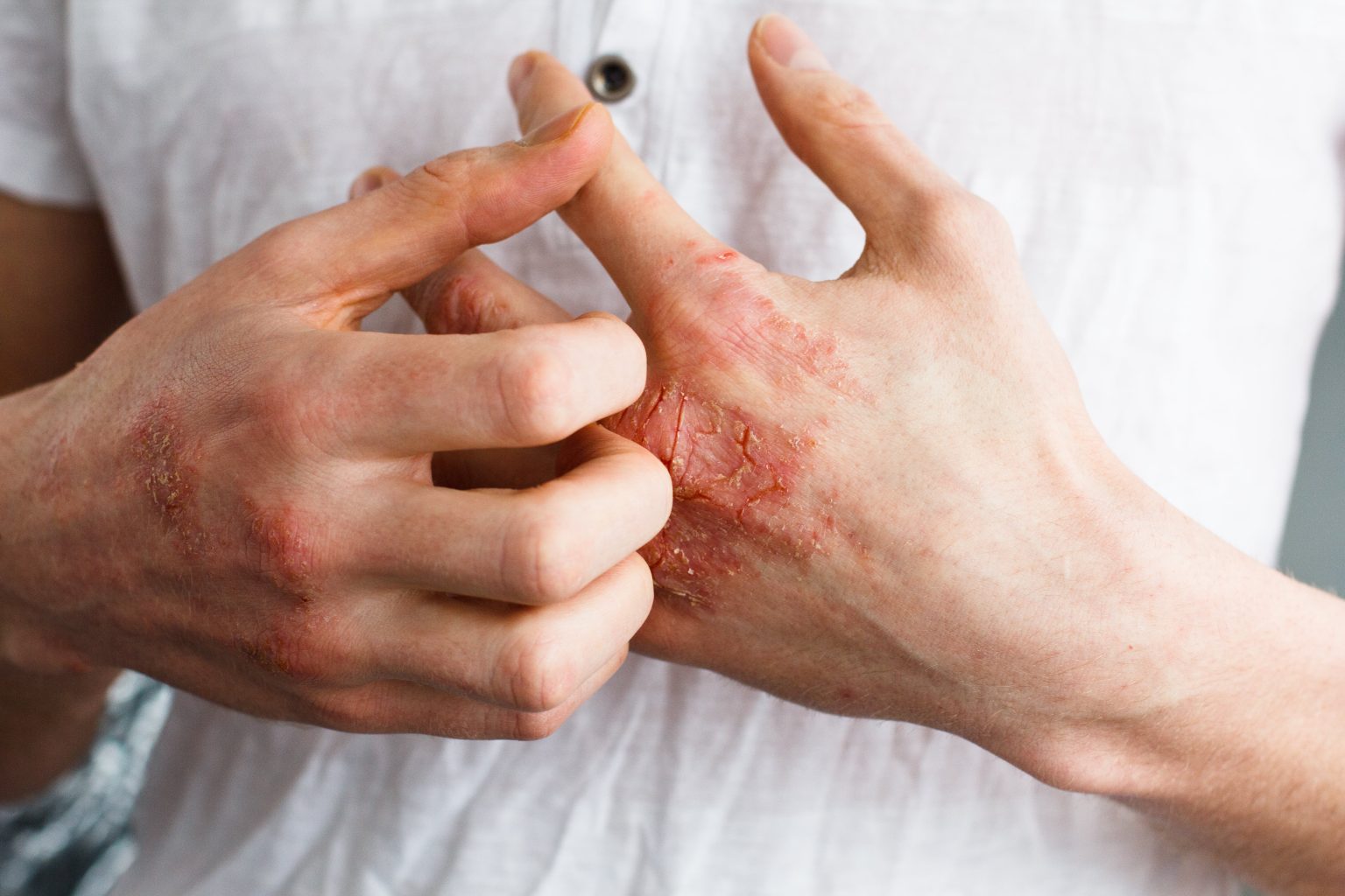 person-with-eczema